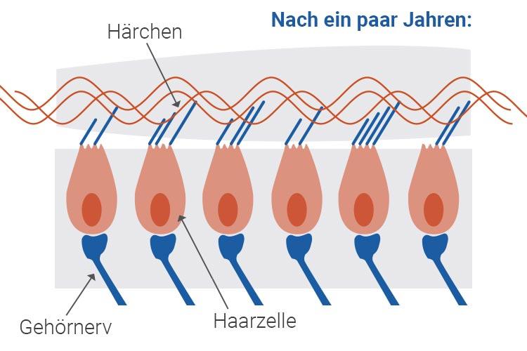 Geschädigte Haarzellen